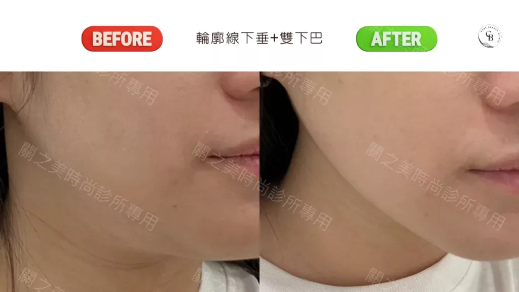 New Doublo 新倍提電音雙波，改善輪廓線下垂+雙下巴 實際案例