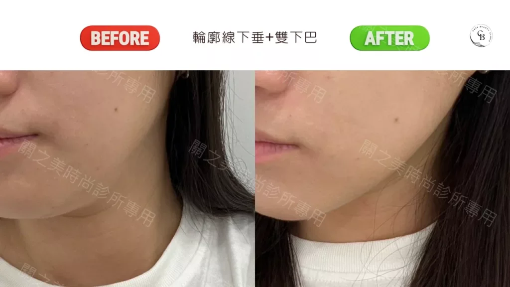 New Doublo 新倍提電音雙波，改善輪廓線下垂+雙下巴 實際案例