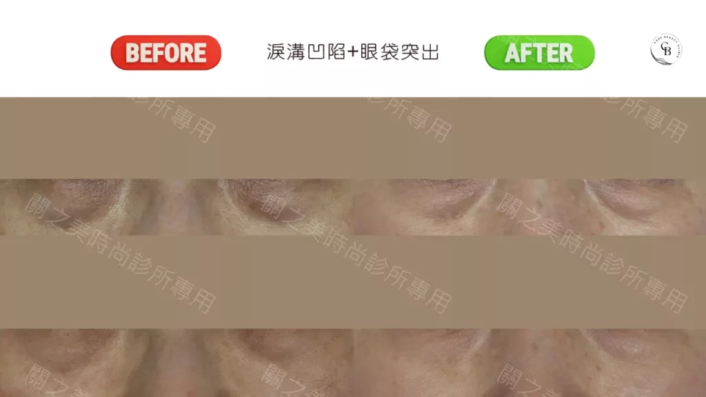 New Doublo 新倍提電音雙波淚溝凹陷+眼袋突出實際案例