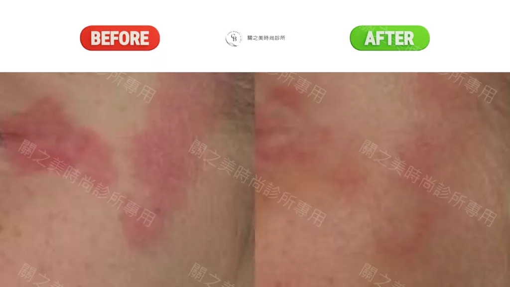 葡萄酒色斑 實際案例