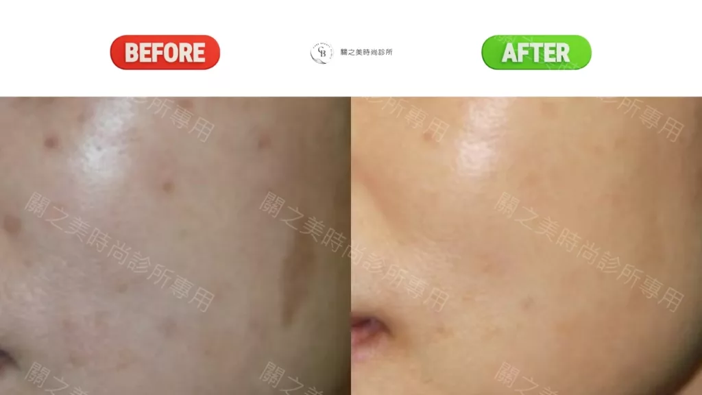 色素斑 實際案例