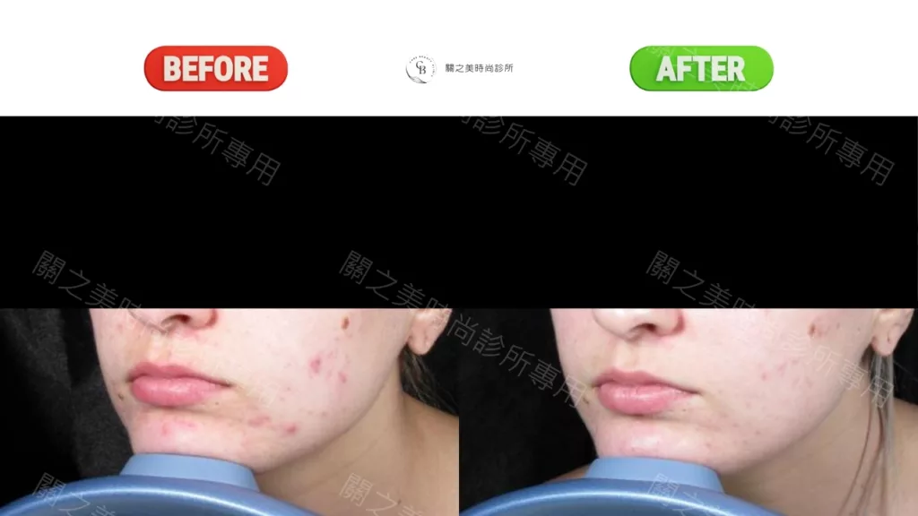 痤瘡 實際案例