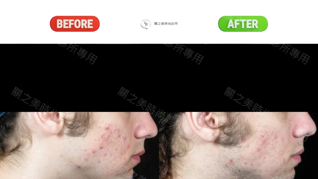 痤瘡 實際案例