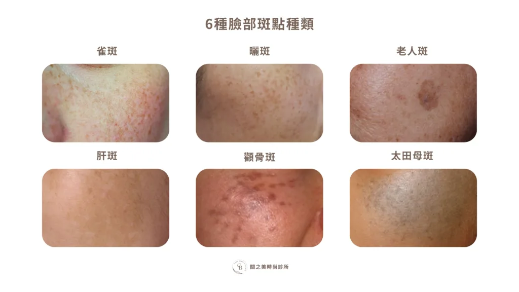 斑點類型全圖鑑：雀斑、曬斑、肝斑，醫美雷射治療對策全解析