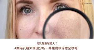 毛孔越來越粗大4大毛孔成因分析蜂巢皮秒治療全攻略