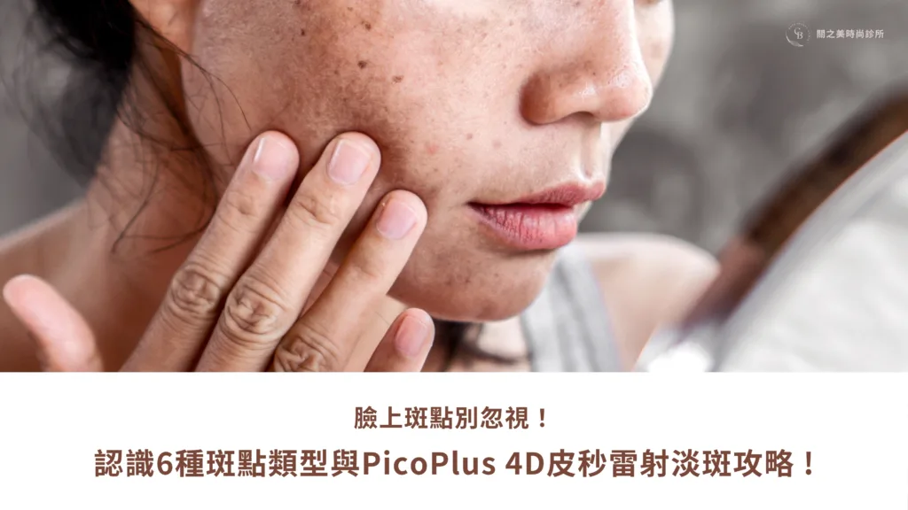 臉上斑點別忽視！ 認識6種斑點類型與PicoPlus 4D皮秒雷射淡斑攻略